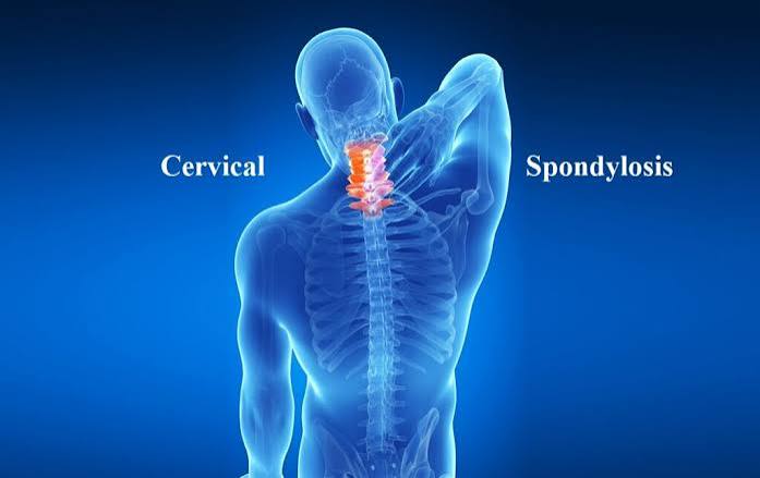 Cervical Spondylosis: Understanding Neck Pain cervical spondylosis