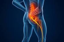 Sciatica: Why Pain Travels From the Back to the Leg sciatica